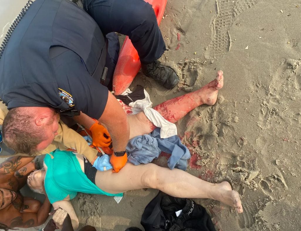  Акула откъсна 9 кг. плът от украинска националистка на плаж в Ню Йорк СНИМКИ 18+