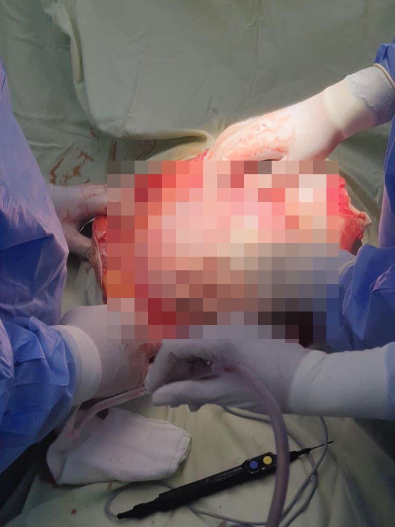 Врачански лекар извади 15-кг тумор от жена и избухна: Човешка глупост! СНИМКИ 18+