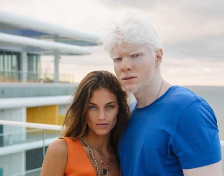 Ангел ли е? Как изглежда детето на грузински модел и най-красивият албинос в света