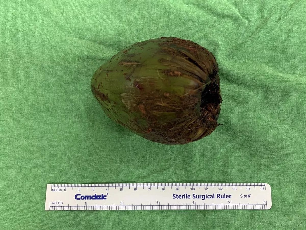 Мъж си заклещи кокосов орех в дупето по време на секс, после стана още по-страшно 