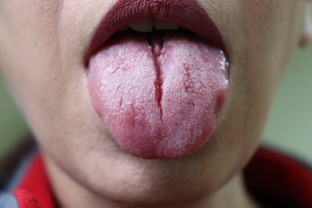 Какво означават браздите по езика за здравето ни