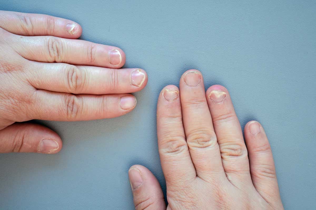 Вижте всички болести, за които сигнализира състоянието на ноктите