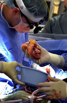 Сърдечната трансплантация зависи от пола на донора
