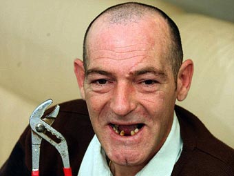 Ветеран от войната в Ирак си извади 13 зъба с клещи