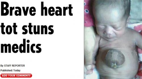 Бебе със сърце на корема живее вече месец
