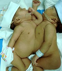 Разделиха сиамски близнаци, свързани в гръдния кош