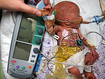 Кардиостимулатор на 750-грамово новородено