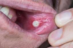Мнозина пренебрегват този симптом на рак на устата
