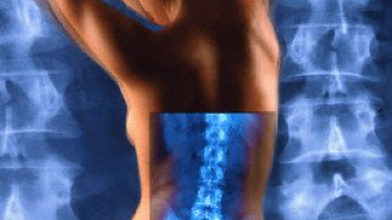 20 факта за остеопорозата