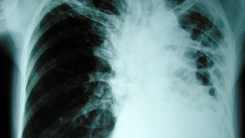 Болните от туберкулоза намаляват 