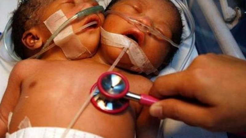 Бебе с две глави се роди в Китай 