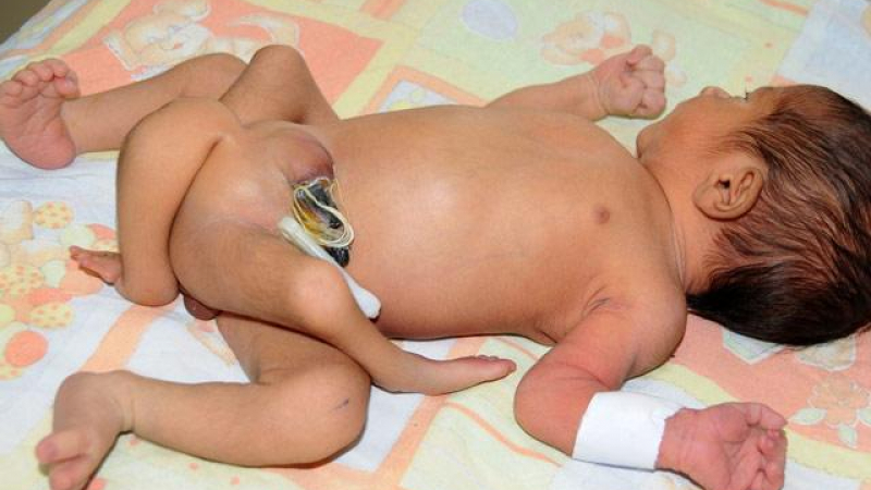 В Пакистан се роди бебе с шест крака 