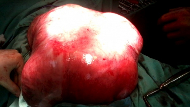 Извадиха 15 кила тумор от корема на пловдивчанка
