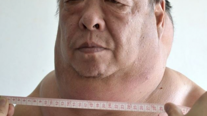 Мъж живее с огромен тумор в шията (СНИМКИ)