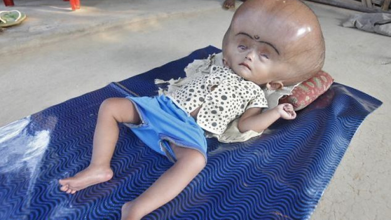 Страшна болест превърна главата на дете в балон