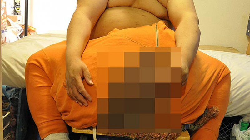 Мъжът с 45-килограмовия тестис след спасителната операция: Пенисът ми стана 2.5 сантиметра