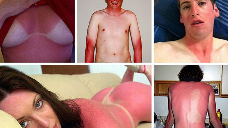Вижте 12-те идиоти с най-малоумните слънчеви изгаряния (СНИМКИ)