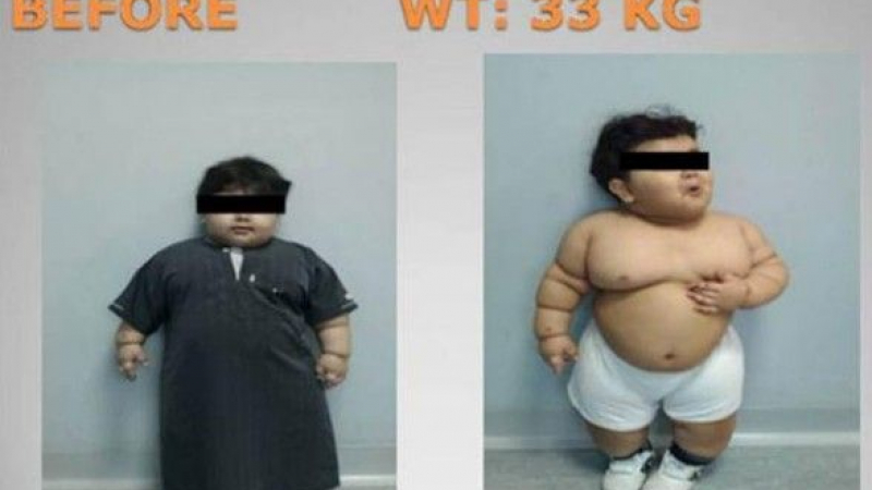 Заради диета 2-годишно дете тежало 33 кг