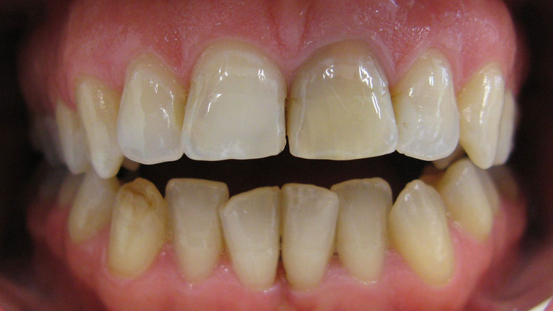 Пациент съди стоматолог за некачествено чене