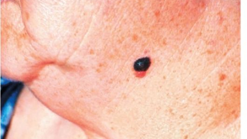 Все повече болни от рак на кожата у нас