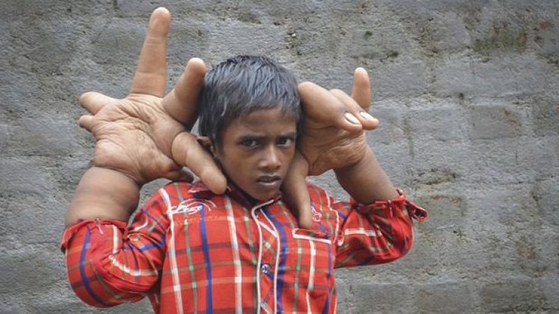 Момче с гигантски ръце хвърли в потрес лекарите в Индия