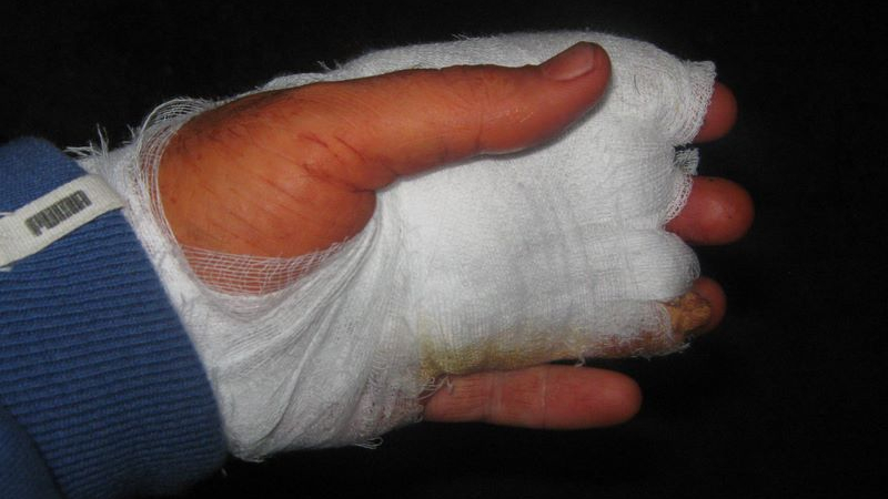 Първо в БЛИЦ: Жена с отрязани пръсти след злополука