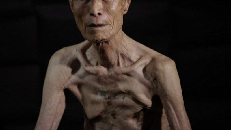 Японец показа белезите си от раните, получени от ядрения взрив в Нагасаки (СНИМКИ)
