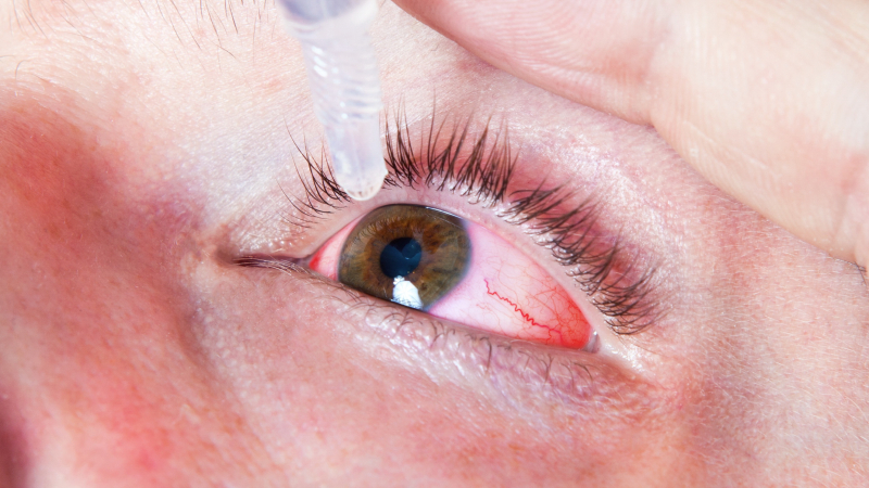 Херпесна инфекция на окото уврежда миглите