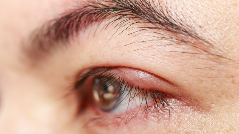 Ечемикът на окото сочи за проблеми с имунитета