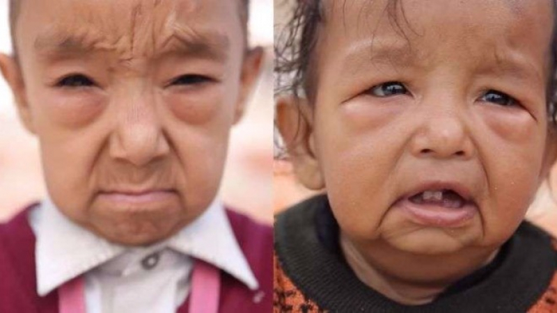 Историята, която разплака милиони по цял свят: Нелечима болест превръща децата в старци (ПОТРЕСАВАЩО ВИДЕО)