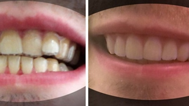 Стоматологията в шок: Студент сам си оправи кривите зъби и спести хиляди долари от брекети (СНИМКИ)