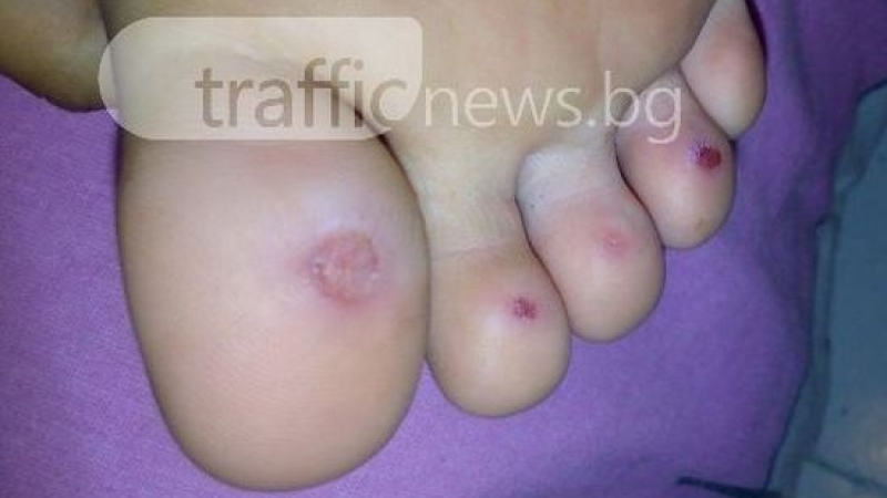 Ужас в Пазарджик: 8-годишно момиченце излезе от детски басейн с разядена кожа! (СНИМКИ)