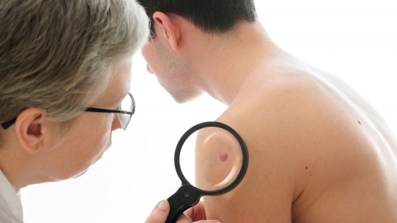 Успех: Учени разкриха причинителя на рак на кожата