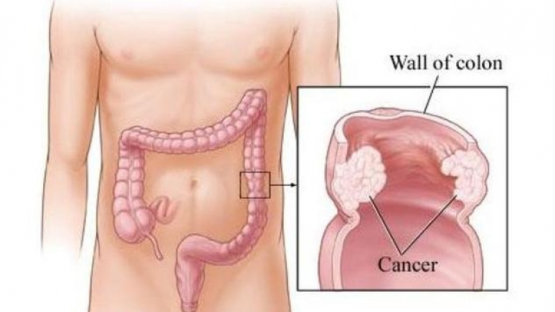 Ако забелязвате тези сигнали, внимавайте! Може да страдате от рак на дебелото черво