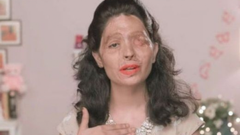 19-годишна индийка, обезобразена с киселина, трогна хора по целия свят (СНИМКИ 18+)