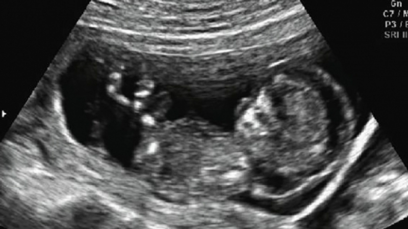 В Благоевград: Нов потресаващ случай с родилка и мъртво от 3 седмици бебе в утробата ѝ