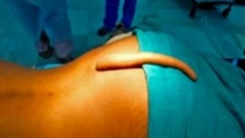 Невиждана операция: Лекари отрязаха 18-сантиметрова опашка на младеж, смятан за бог (СНИМКА)