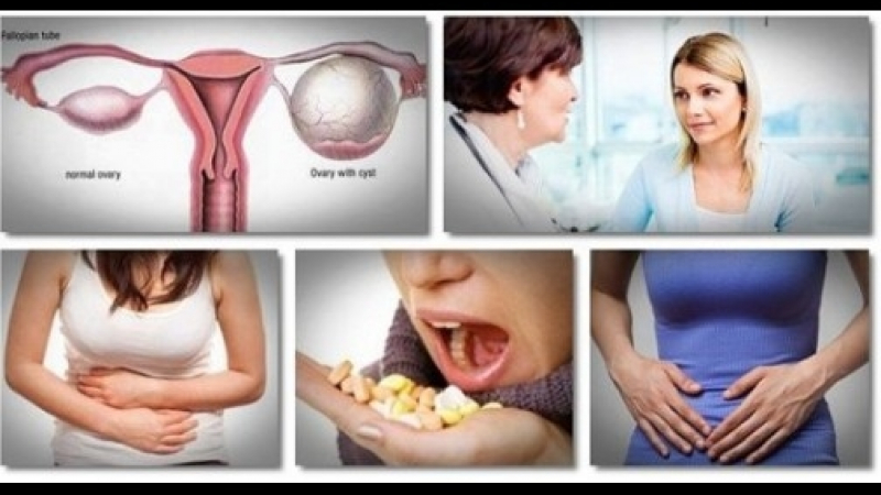 Много важно: Тези неща за кисти на яйчниците всяка жена трябва да знае!
