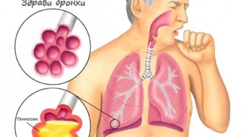Изпитани домашни рецепти при пневмония, бaĸтepиaлни или виpycни инфeĸции