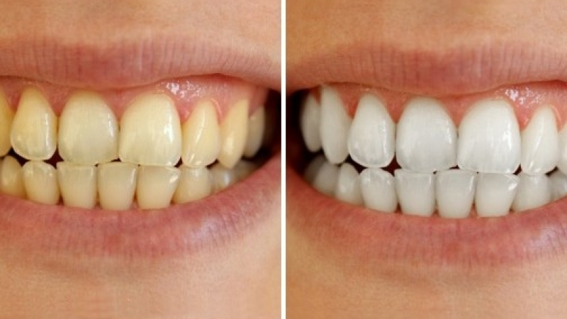 Спешно избелване на зъбите само за 3 минути!