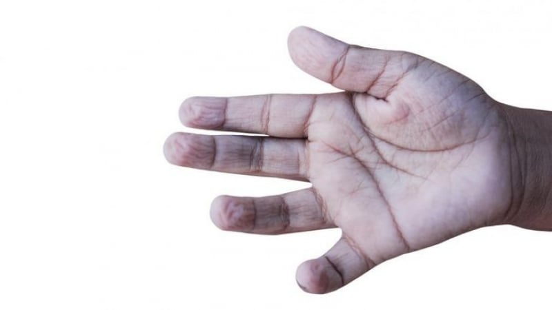 По пръстите на ръцете може да познаете развивате ли диабет