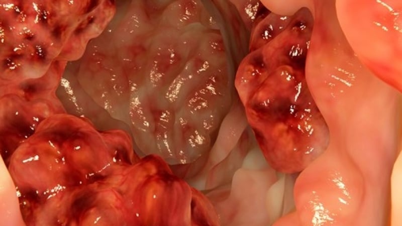 Експерт с ценни съвети: Как да разберем, че имаме проблем с рак на дебелото черво 