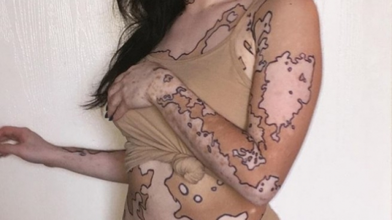 Момиче с трагична съдба превърна недъга си в секси карта на света (СНИМКИ)