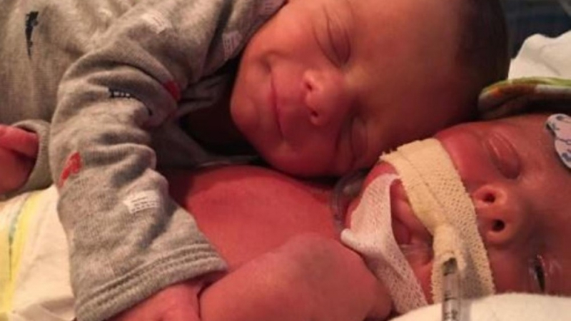 СНИМКА на последна прегръдка на бебе с умиращото му близначе разплака света