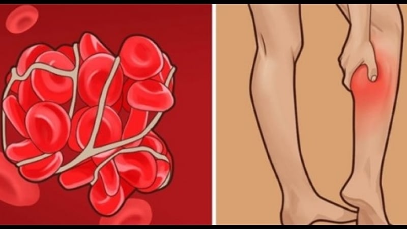 6 общи признака на тромбоза - това са симптомите, които не бива да пренебрегвате!