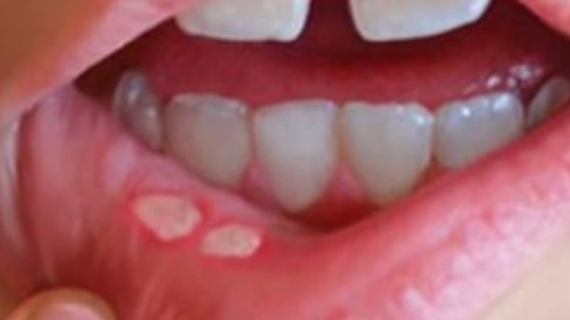 Невидими алайнери коригират криви зъби