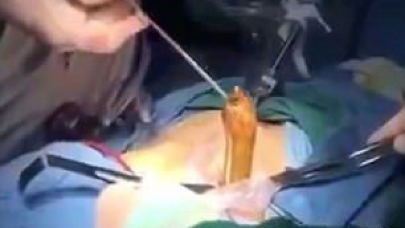 Ужасяващ момент: Лекари вадят змиорка от тялото на пациент „след нестандартен секс” (ВИДЕО 18+)