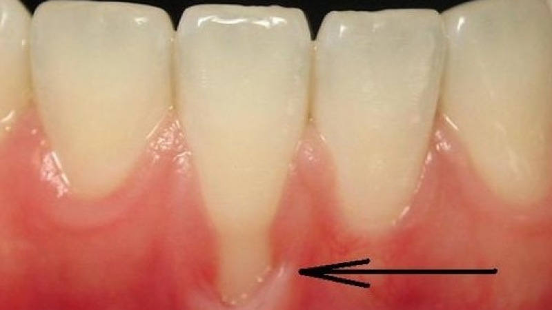 Тези чудотворни методи ще предпазят зъбите и венците ви!