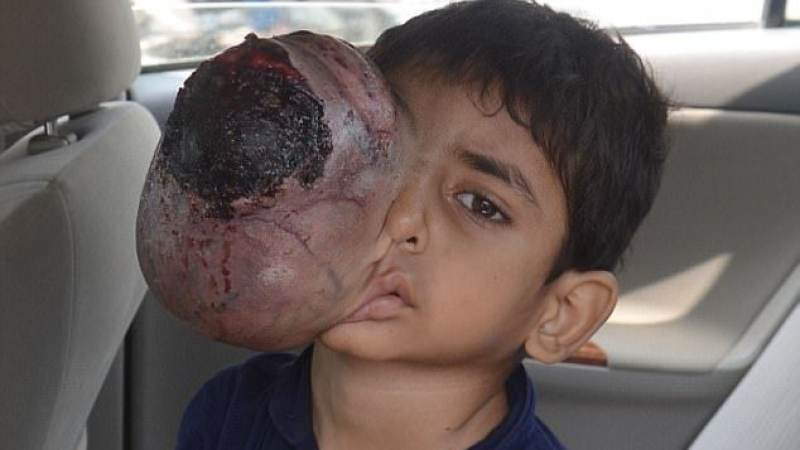 Момче страда всеки ден от окото-тумор, без лечение умира до седмици (СНИМКИ)