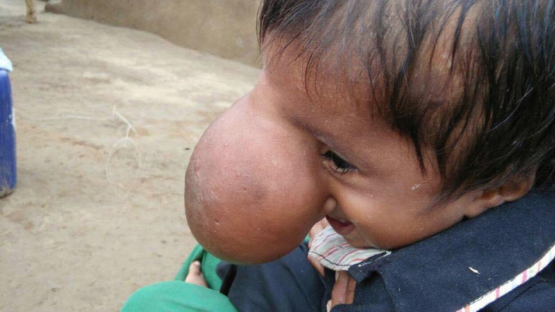 Ужасна съдба! Дете с огромен нос не може да се храни и да вижда нормално (СНИМКИ 18+) 